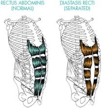 Diastasis Recti